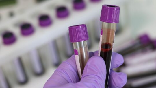 rajkotupdates.news:emm-negative-rare-blood-group-found-in-rajkot-man-11th-such-case-worldwide